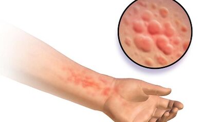 อาการของ schistosomosis ในมนุษย์